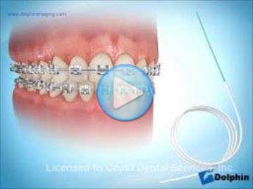 Flossing with Braces