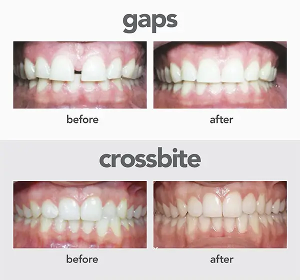 CoastClear Aligners® 8 gaps-crossbite