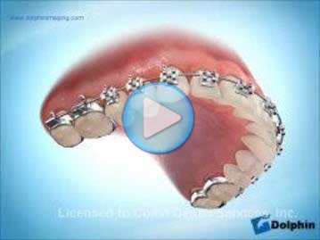 Hawley Retainer