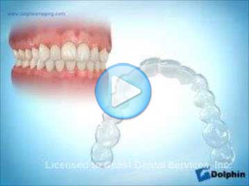 Invisible Aligners