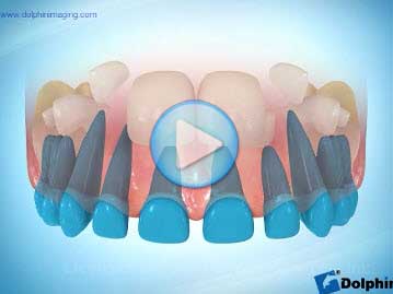 Missing Maxillary Lateral Incisor
