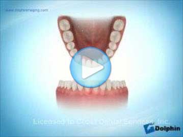 Narrow Archform Mandible