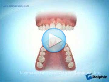 Narrow Archform Maxilla