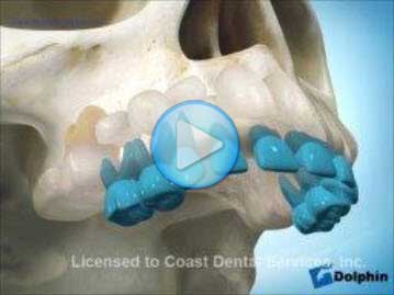 Palatal Eruption of Maxillary Cuspid