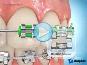 Parts of Braces