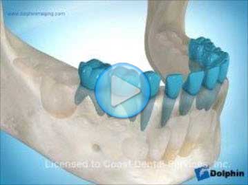 Retained Deciduous Second Molar