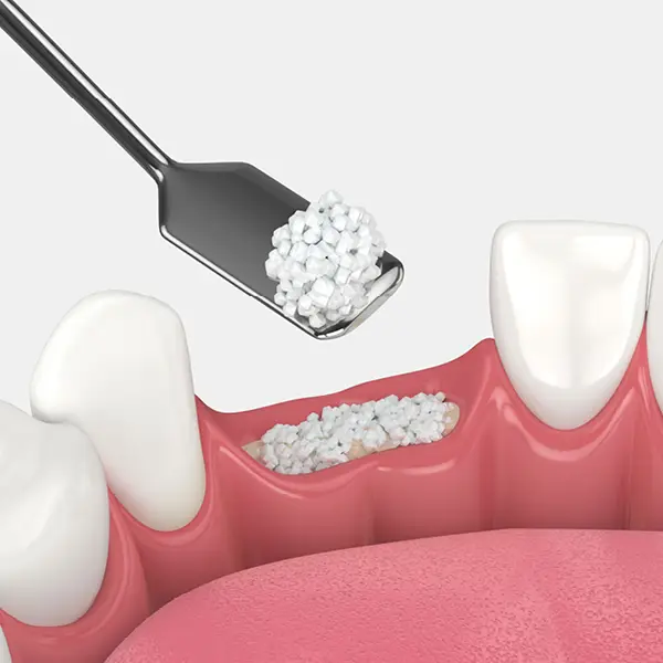 Bone Grafting
