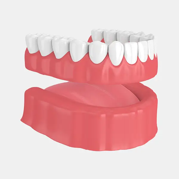 Replacement Dentures & Partial Dentures 2 Removable Permanent Dentures and Fixed Permanent Dentures