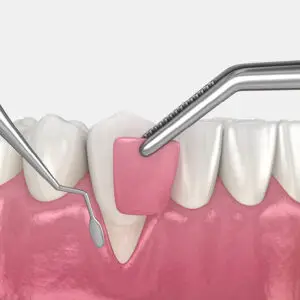 Gingival (Gum) Grafting / Soft Tissue Grafting 1 Gum Grafting