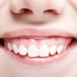 Gummy Smile