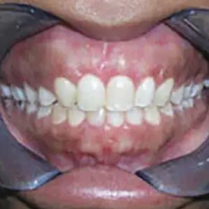 gummy-smile-after