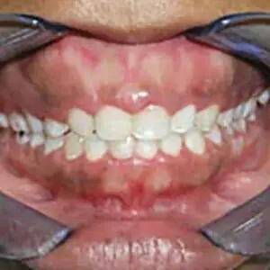 gummy-smile-before