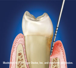 slight chronic periodontitis