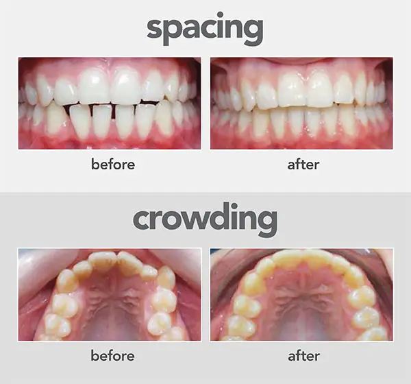 CoastClear Aligners® 9 spacing-crowding