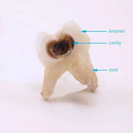 tooth-decay-1