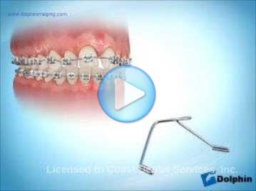 Trans Palatal Arch