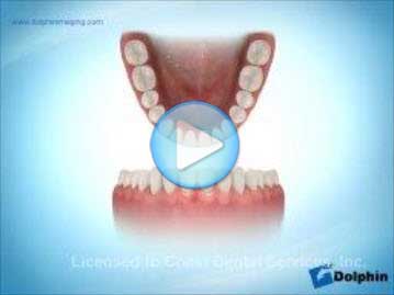 V Shaped Archform Mandible